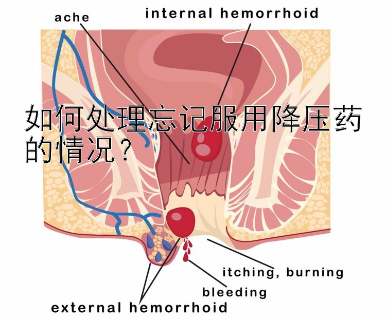 如何处理忘记服用降压药的情况？