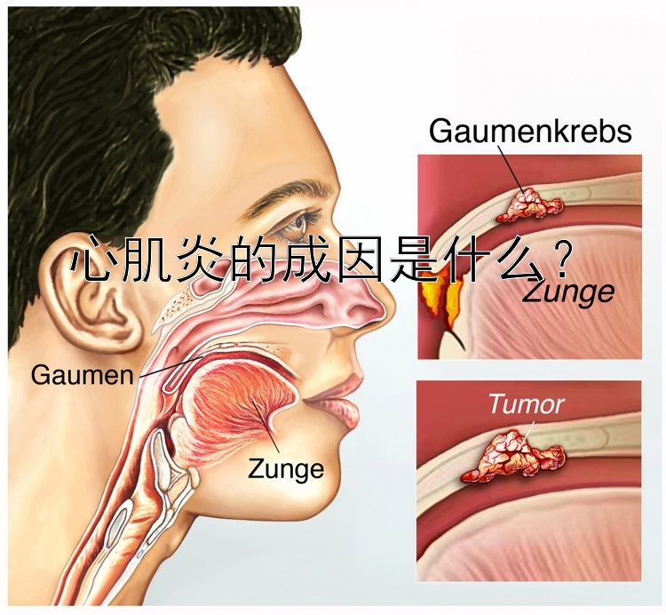 心肌炎的成因是什么？