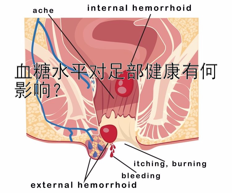 血糖水平对足部健康有何影响？