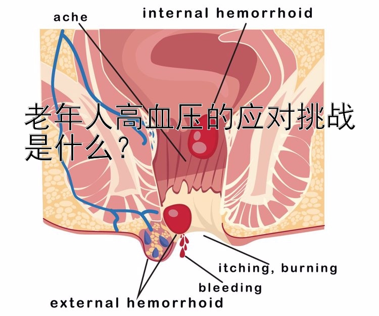 老年人高血压的应对挑战是什么？