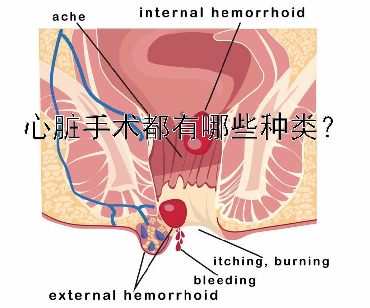 心脏手术都有哪些种类？