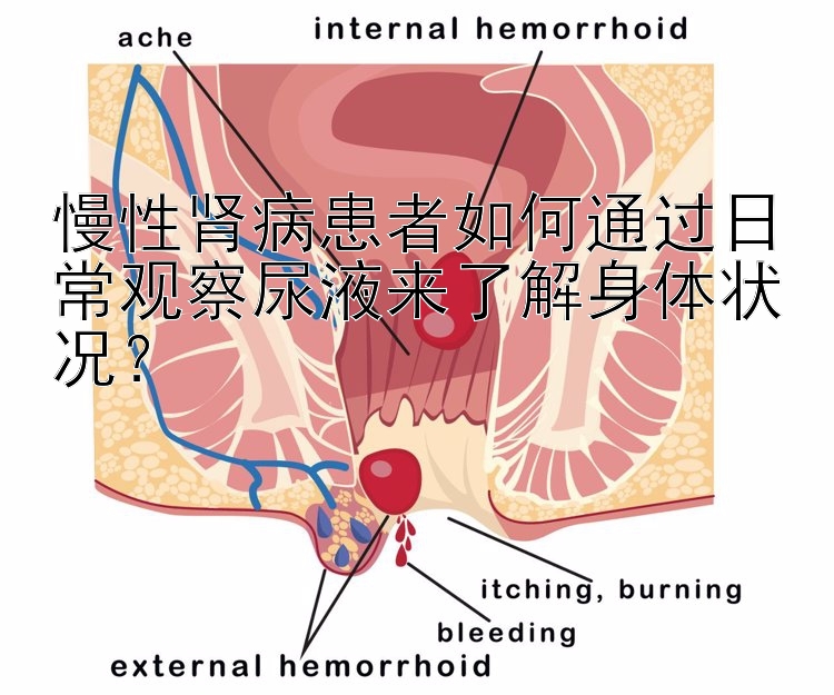 慢性肾病患者如何通过日常观察尿液来了解身体状况？