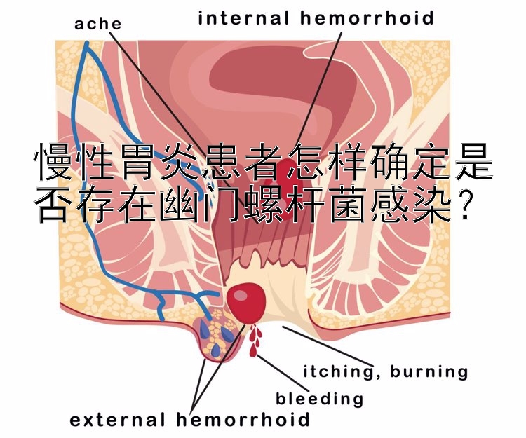 慢性胃炎患者怎样确定是否存在幽门螺杆菌感染？